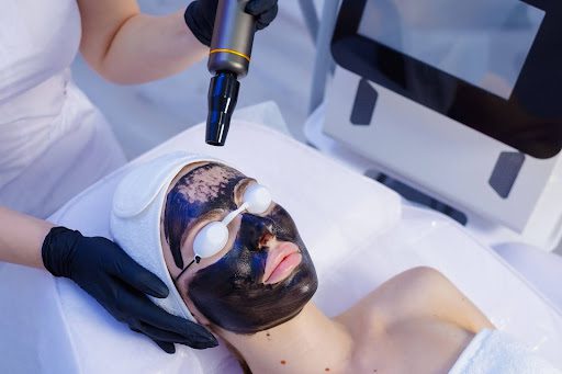 skin-rejuvenation-with-carbon-laser-facials-explained